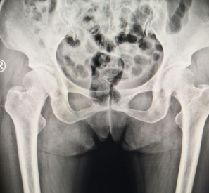 【中国江苏网】智慧骨科丨定位精度达亚毫米 骨科机器人微创完成股骨颈骨折手术