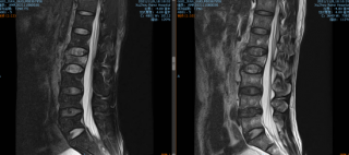 【智慧骨科】腰椎骨折20小时，我院脊柱科借助天玑骨科机器人，2cm切口下实施紧急救治！